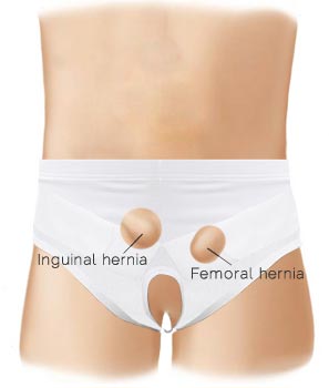 Underworks Men's and Women's Inguinal Hernia Double or Single Truss 